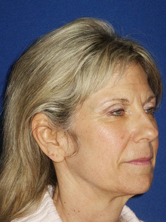 Facelift, Endoscopic Browlift, Upper and Lower Blepharoplasty, Perioral Dermabrasion, Fat injections to the Upper and Lower Lips before 249130