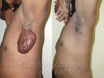 Keloid Removal before 615740