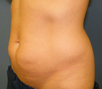 CoolSculpting 621991
