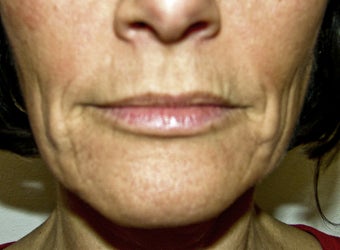 Sculptra, Radiesse, Restylane, and Botox Injection, and Obagi Nu Derm before 257711