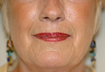 Before and Resurfacing Coblation Skin Resurfacing after 65325