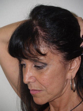 Hair Transplant into Scar after 336980