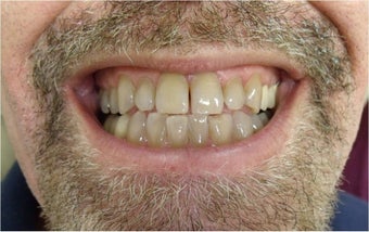 Zoom! Laser Whitening before 365946