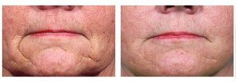 Restylane to wrinkles around mouth before 6269