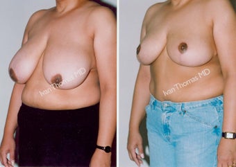 Breast Reduction before 243741