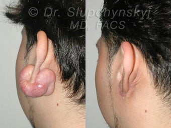 Keloid Removal after 551920