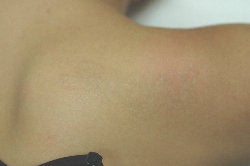 Laser Tattoo Removal after 203258
