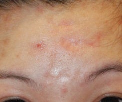 scar acne before treatment laser atrophic co2 subcision resurfacing forehead seattle philip young scars close dermabrasion dr facial example surgery