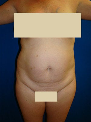 Tummy Tuck Surgery (Abdominoplasty) before 151559