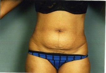 Tummy Tuck before 215126