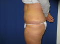 Abdominoplasty after 228292