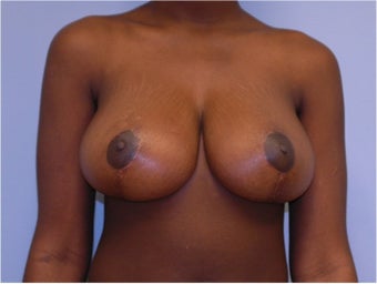 Breast Reduction after 258246