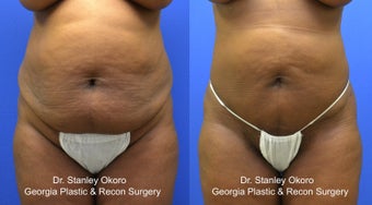 Mini Tummy Tuck before 568396