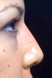 Lunch Time Nose Job using Radiesse after 152207