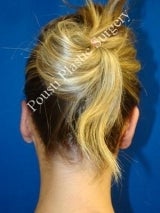 Ear Surgery (Otoplasty) after 616517