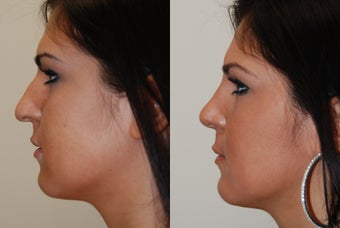 Rhinoplasty Surgery before 204598