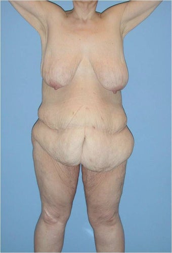 Body Lift & Breast Lift before 529675