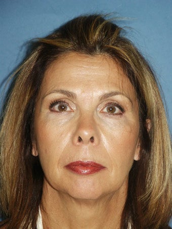 Chin augmentation with facial rejuvenation before 250149