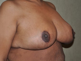 Breast Reduction 530711