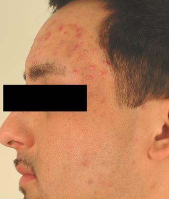 Laser Acne Treatment before 82957