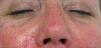 Juvederm for lower eyelid hollows after 77466