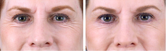 Botox Cosmetic before 253623