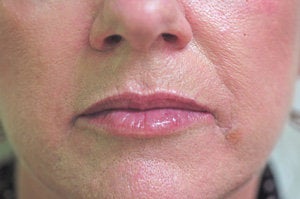 Restylane lip injections after 93361