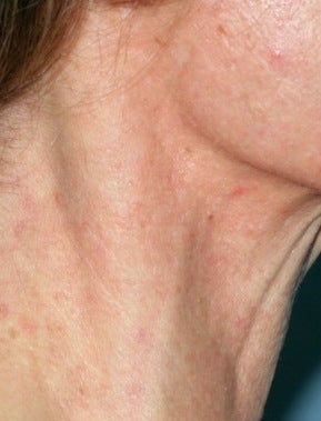 Vbeam laser treatment after 374531