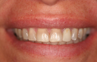 Porcelain Veneers Smile Makeover before 164361