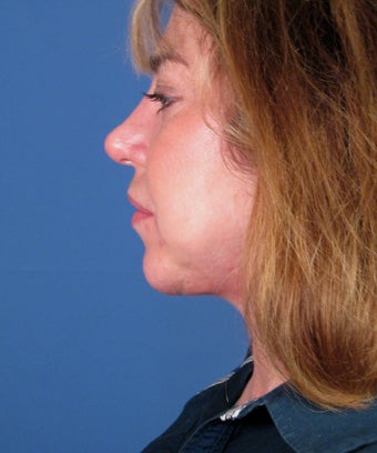 Chin Implant after 550579