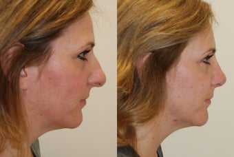 Rhinoplasty Surgery. 2 months post-op. before 526360
