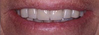Dental Implants after 510605