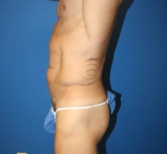 High-Definition Liposuction 402412