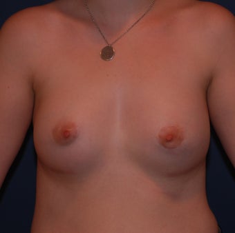 Reconstruction of Tubular Breast Deformity after 555981