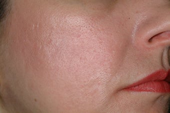 Fraxel Laser after 86802