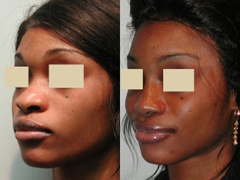 African American Rhinoplasty before 135818