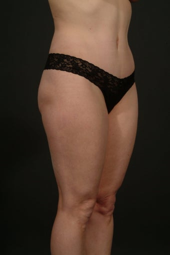 Tummy tuck with hip liposuction after 163042
