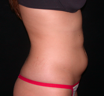 Liposuction before 283436
