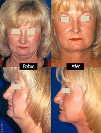 Facelift before 97297