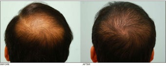 Crown (Vertex) Hair Transplant before 134780