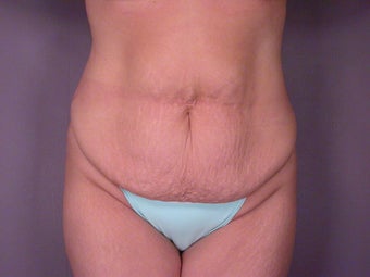Tummy Tuck before 325615