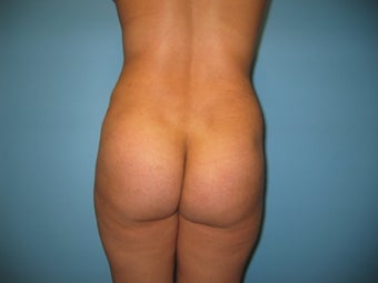 Buttock augmentation (Brazilian buttock lift) after 287962