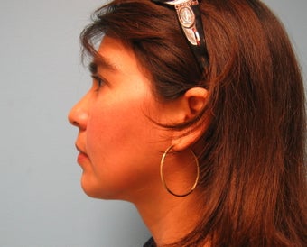 liposuction of chin after 284104