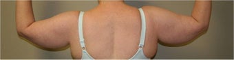 SmartLipo Arms Bilateral before 109336