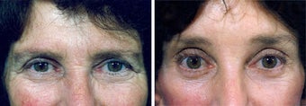 Forehead Lift before 652143