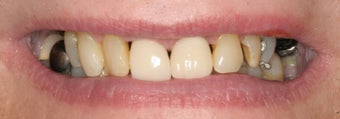 Full mouth reconstruction before 486454