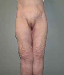 Lower body lift after 282551