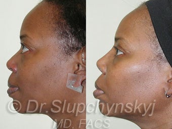African American Rhinoplasty after 525625