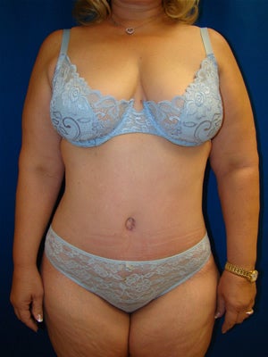 Extended Tummy Tucky Surgery (abdominoplasty) after 133914