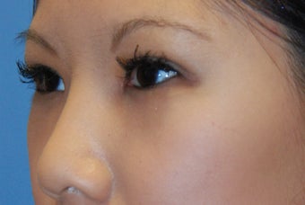 Asian blepharoplasty after 199356